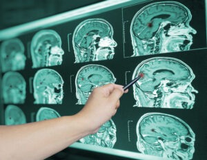 Stillwater Traumatic Brain Injury Attorney